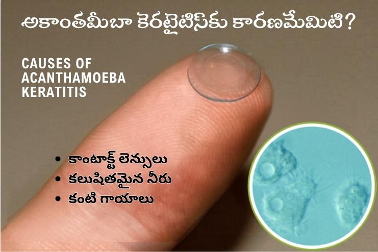 What causes acanthamoeba keratitis
