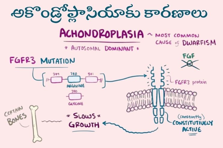 What causes achondroplasia