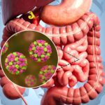What is Norovirus