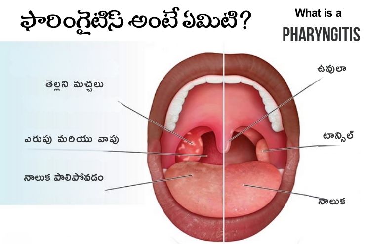 What is a Pharyngitis