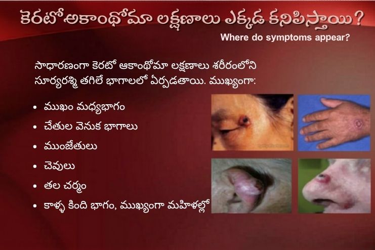 Where do symptoms appear