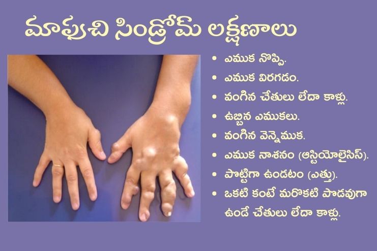 symptoms of Maffucci syndrome