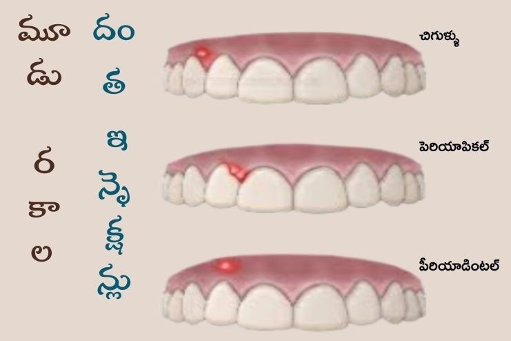 types of abscess