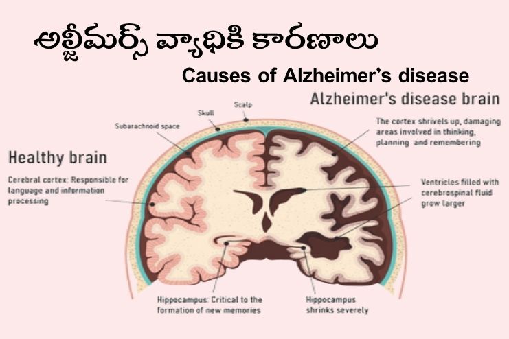 Causes of Alzheimer’s disease