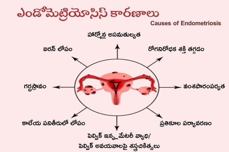 Causes of Endometriosis