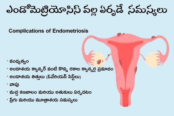 Complications of endometriosis