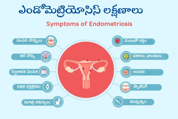 Endometriosis Symptoms