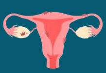 ఎండోమెట్రియోసిస్: కారణాలు, లక్షణాలు, ప్రమాద కారకాలు Endometriosis_ causes, symptoms and risk factors