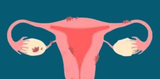 ఎండోమెట్రియోసిస్: కారణాలు, లక్షణాలు, ప్రమాద కారకాలు Endometriosis_ causes, symptoms and risk factors