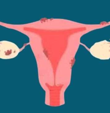 ఎండోమెట్రియోసిస్: కారణాలు, లక్షణాలు, ప్రమాద కారకాలు Endometriosis_ causes, symptoms and risk factors
