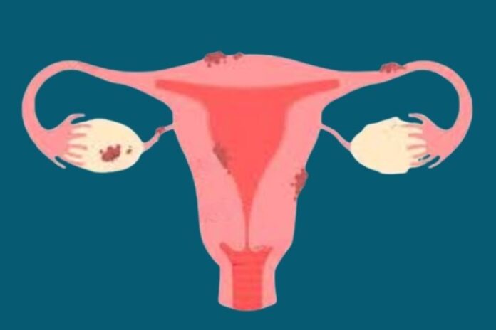 Endometriosis_ causes, symptoms and risk factors