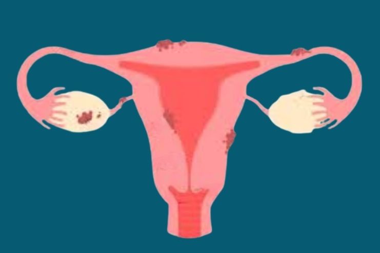 ఎండోమెట్రియోసిస్: కారణాలు, లక్షణాలు, ప్రమాద కారకాలు - <span class='sndtitle'></img>Endometriosis: causes, symptoms and risk factors </span>