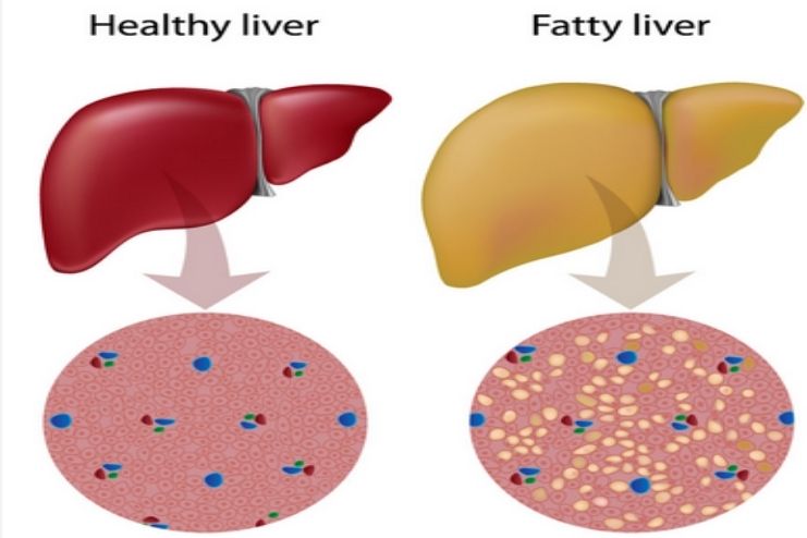How does liver fat form