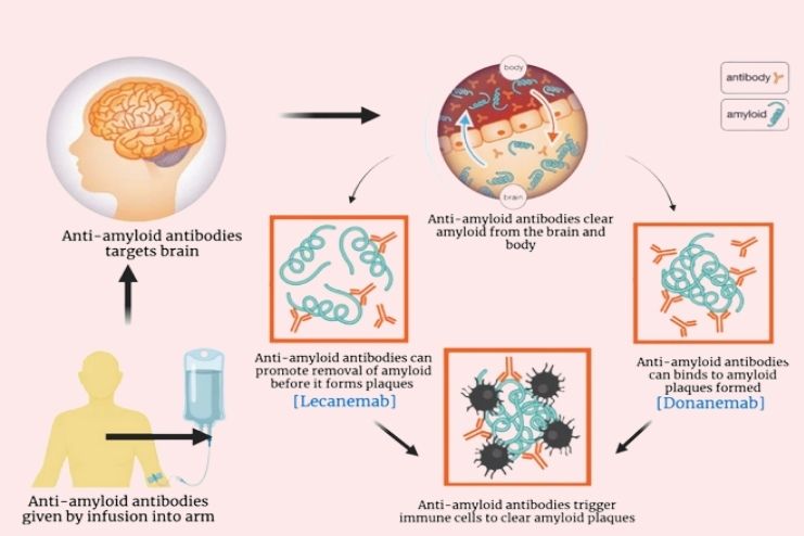 Lecanemab or Donanemab