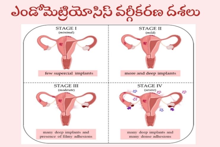Stages of endometriosis