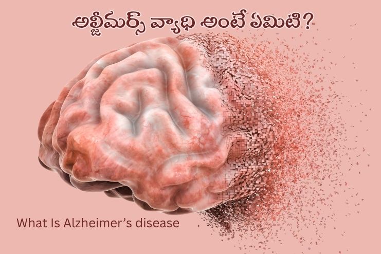 What Is Alzheimer’s disease