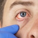 What is Conjunctivitis