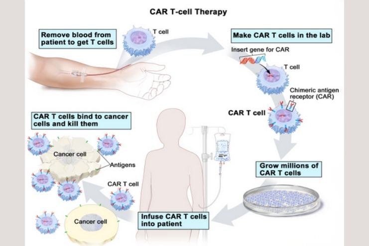 CAR T-cell Therapy