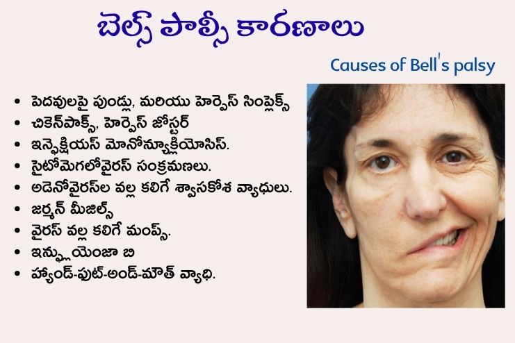 Causes of Bell's palsy