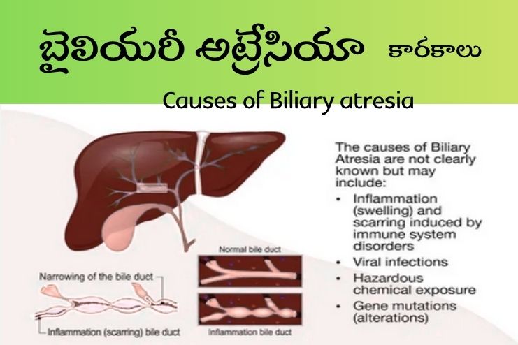 Causes of Biliary atresia