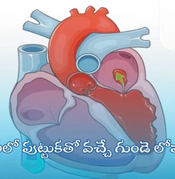 పిల్లలలో పుట్టుకతో వచ్చే గుండె లోపాలు: కారణాలు, నిర్ధారణ, చికిత్స Congenital heart defects in children_ Causes, and Treatments