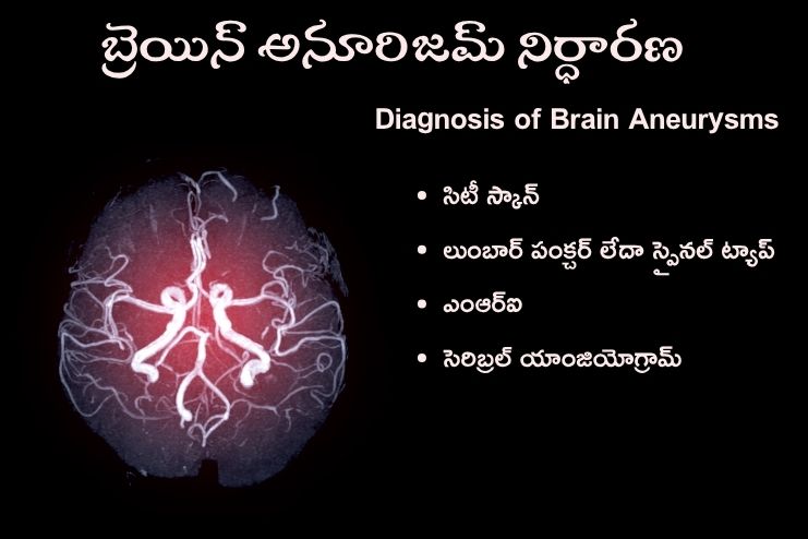 Diagnosis of Brain Aneurysms