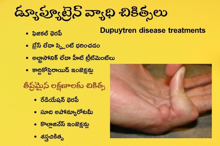 Dupuytren disease treatments