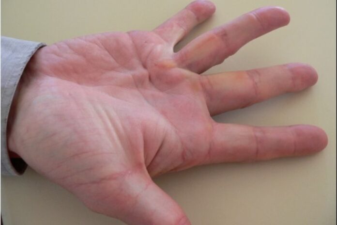 Dupuytren’s Disease