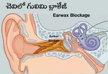 చెవిలో గులిమి బ్లాకేజీ: లక్షణాలు, కారణాలు, తొలగింపు పద్ధతులు Earwax Blockage_ Signs, Causes