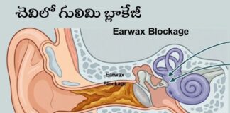 చెవిలో గులిమి బ్లాకేజీ: లక్షణాలు, కారణాలు, తొలగింపు పద్ధతులు - Earwax Blockage: Signs, Causes, and Safe Removal Methods Earwax Blockage_ Signs, Causes