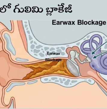 చెవిలో గులిమి బ్లాకేజీ: లక్షణాలు, కారణాలు, తొలగింపు పద్ధతులు Earwax Blockage_ Signs, Causes