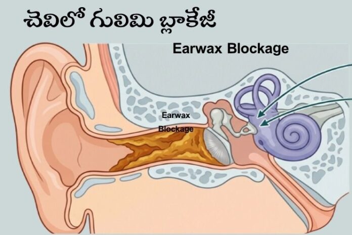 Earwax Blockage_ Signs, Causes Earwax Blockage_ Signs, Causes