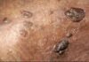 జననేంద్రియ మొటిమలు: కారకాలు, లక్షణాలు, చికిత్స Genital warts_ Causes, Symptoms and Treatment