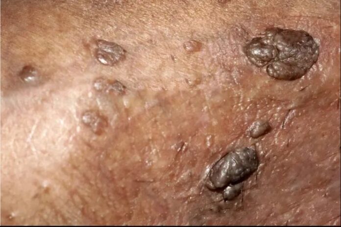 Genital warts_ Causes, Symptoms and Treatment