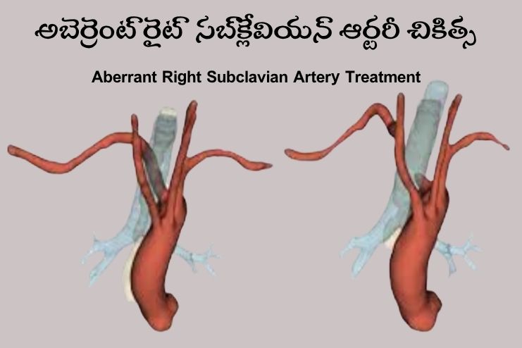 How is an ARSA treated