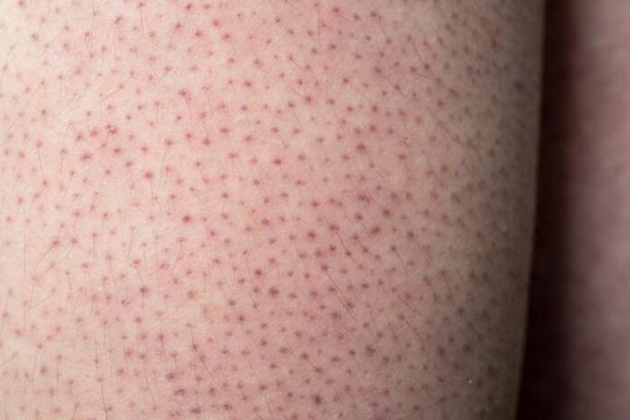 Keratosis Pilaris Keratosis Pilaris
