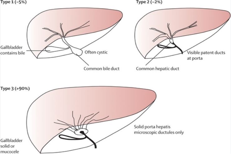 Nonsyndromic biliary atresia