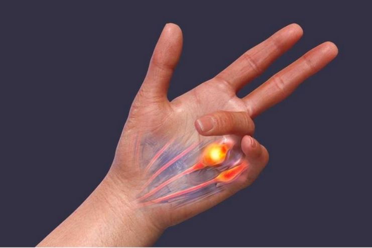 Prognosis of Dupuytren disease