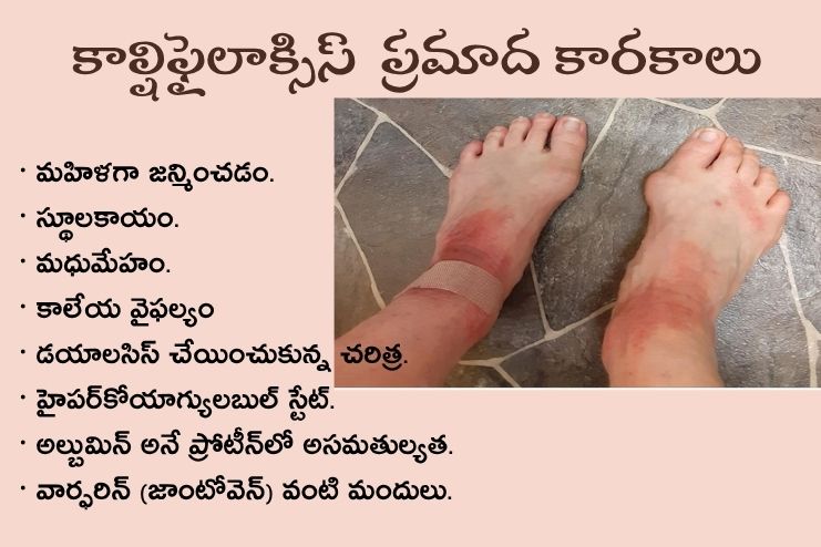 Risk factors of Calciphylaxis
