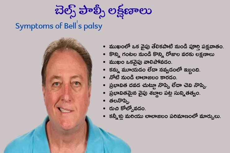 Symptoms of Bell's palsy