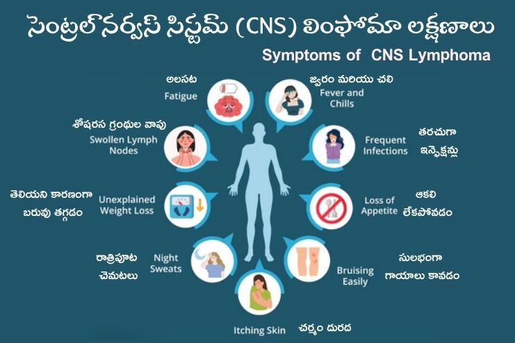 Symptoms of CNS Lymphoma