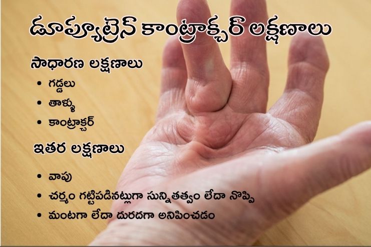 Symptoms of Dupuytren contracture