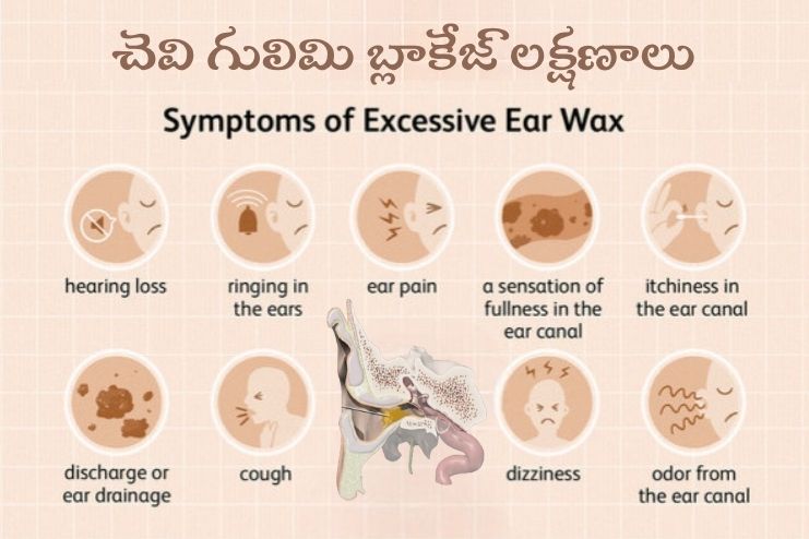 Symptoms of Earwax Blockage