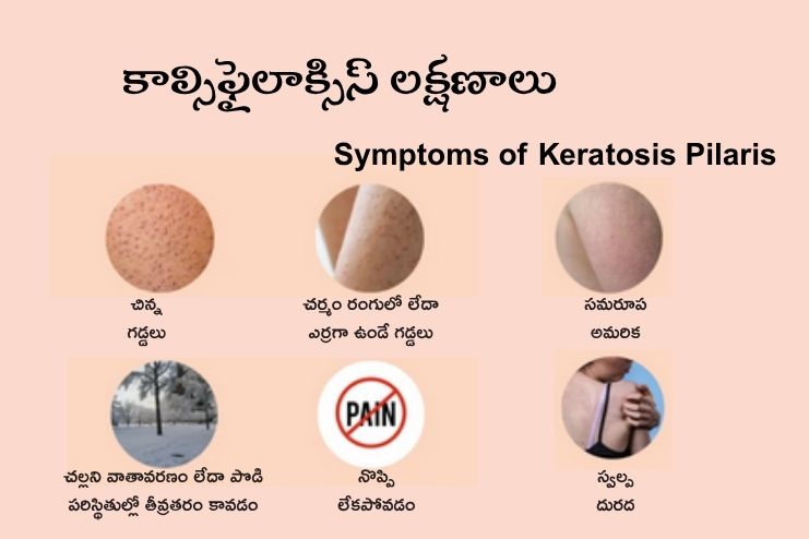 Symptoms of Keratosis Pilaris