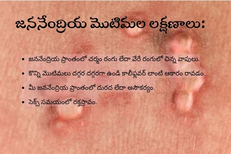 Symptoms of genital warts