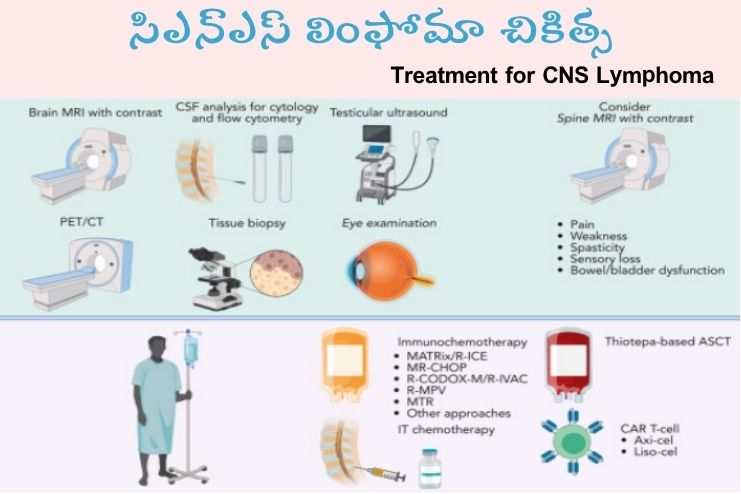 Treatment for CNS Lymphoma
