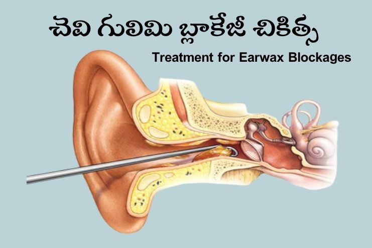 Treatment for Earwax Blockage
