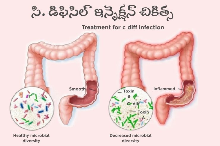 Treatment for c diff infection