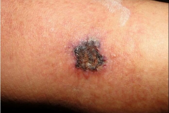 What Is Calciphylaxis
