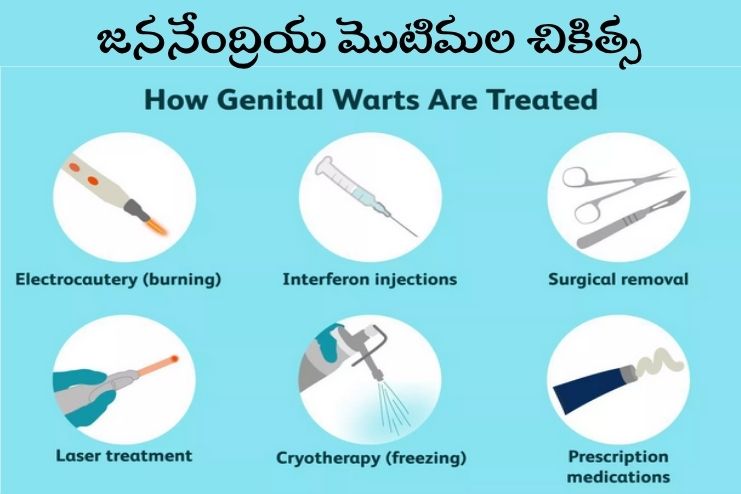 treatment for genital warts